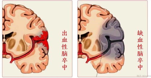 女生突发脑出血，症状与语言障碍的交织